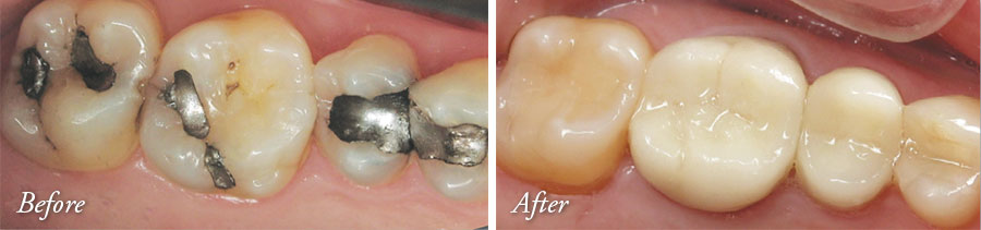 Tooth-Colored Fillings and Crowns - Lake Jackson Dentist Comprehensive Dentistry for All Ages