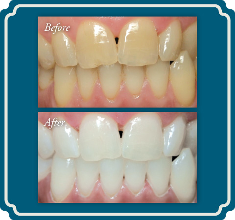 Teeth Whitening Before and After - Lake Jackson TX Dentist Comprehensive Dentistry for All Ages