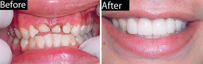 Porcelain Crowns Before and After - Comprehensive Dentistry for All Ages in Lake Jackson TX