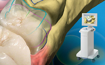 CEREC One-Visit Porcelain Crowns
